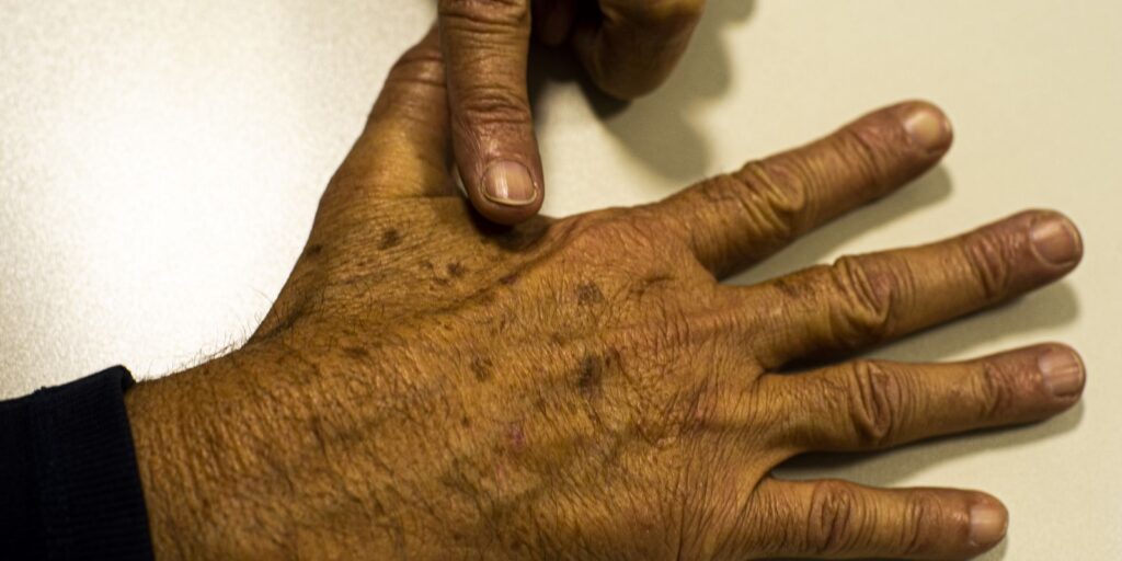 desinformacao-sobre-cancer-de-pele-afeta-diagnostico,-diz-instituicao